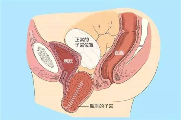 【產(chǎn)后修復】盆腔臟器脫垂，你有嗎？