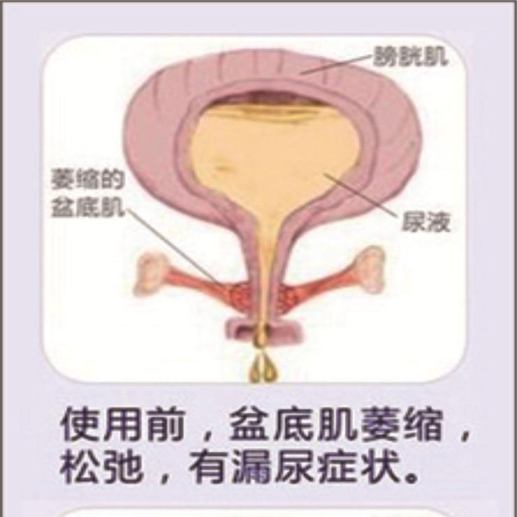 產(chǎn)后盆底肌康復(fù)|“社交癌”盯上你了嗎？