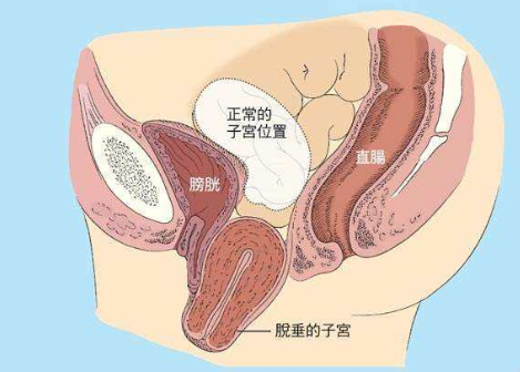 人們常說，產(chǎn)后女性做好盆底肌修復(fù)是關(guān)鍵，但盆腔器官的脫垂你也得注意