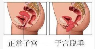 產(chǎn)后恢復，盆底肌修復的功能障礙