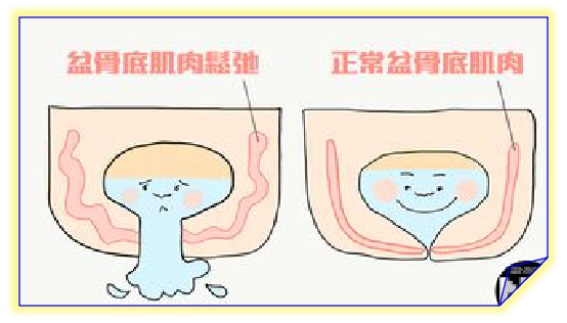 盆底康復(fù)治療怎么做，盆底肌修復(fù)常見(jiàn)的十大問(wèn)題（中）