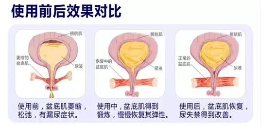 產(chǎn)后盆底肌怎么修復