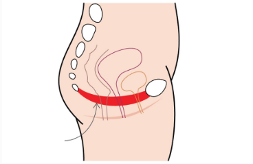 腹直肌修復(fù)