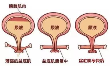 盆底肌修復(fù)儀器.jpg